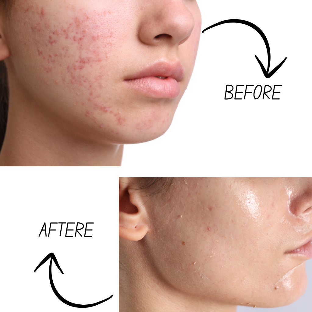 Retinol Night Serum | For Acne Marks, Pores & Glow in 4 Weeks